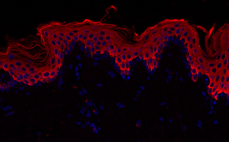 Normal skin: nuclei (DAPI Blue colorant) and epithelial cells (CK10 red colorant)